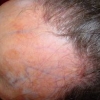 Alopecia fibrosante frontale e lichen planus pigmentoso: qual è il legame tra i due?