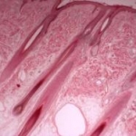 L'alopecia areata: infiltrazione di cellule Th17 nel derma, in particolare attorno ai follicoli dei capelli