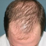 Carbossiterapia e caduta dei capelli