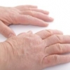 Decorso clinico dell'eczema irritante da contatto professionale delle mani
