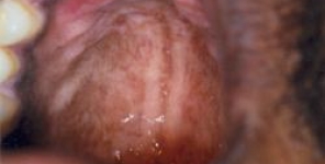 Iperpigmentazione del palato duro secondaria alla terapia cronica con clorochina: rapporto di cinque casi