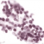Istoplasmosi disseminata in pazienti con infezione da HIV in una regione a nord-est del Brasile