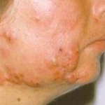 Discussione sulla terapia dell'acne a base di isotretinoina