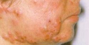 Alta dose di isotretinoina nell'acne volgare: i risultati di un trattamento migliorato e qualità della vita