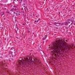 Nei fibroblasti cheloidi, la simvastatina inibisce l'espressione del collagene di tipo I, di CTGF e α-SMA indotta dal fattore di crescita trasformante-β1