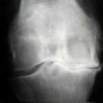 L'infezione fungina del piede potrebbe essere la causa iniziante e di mantenimento dell'osteoartrosi del ginocchio