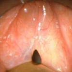 Le leghe dentali al nichel possono indurre attacchi di edema laringeo: un caso clinico