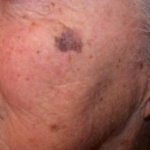 Il trattamento ai raggi di Grenz della lentigo maligna e del melanoma tipo lentigo maligna precoce