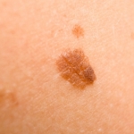 Pazienti ad alto rischio melanoma: come evitare biopsie non necessarie?