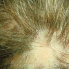 Lichen planopilaris dopo trapianto di capelli: rapporto di 17 casi.