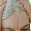 Risultati istopatologici distinti nell'alopecia con morfea lineare (en coup de sabre)