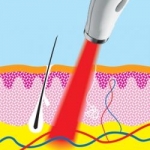 Valutazione clinica dell'efficacia della terapia laser a bassi livelli per il lichen planus orale: una serie prospettica di casi