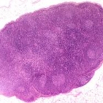 Il linfonodo sentinella nel carcinoma a cellule di Merkel: eseguire o no la biopsia?