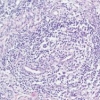 La papulosi linfomatoide di tipo D: un quadro istologico aggressivo per una malattia indolente