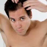 Indagine di quattro nuovi loci di suscettibilità all'alopecia androgenetica maschile