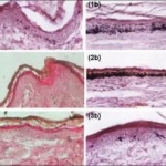 Effetti in vitro del tamoxifene sulla melanogenesi cutanea