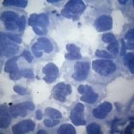 Inattivazione fotodinamica dei fibroblasti umani primari attraverso il blu di metilene e il blu di toluidina O
