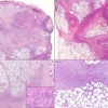 Sindrome di Sweet necrotizzante: Una nuova variante della dermatosi neutrofila che imita la fascite necrotizzante