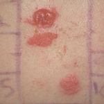 Patch test positivi al nichel/cobalto e alte concentrazioni di nichel nel sudore dei pazienti con dermatite atopica intrinseca