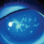 Risultati oculari nei pazienti con psoriasi