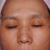 Laser Nd:YAG pulsato lungo sulle rughe periorbitali nei pazienti asiatici: Studio randomizzato di metà volto