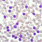 I marcatori delle cellule tumorali circolanti nel sangue periferico si correlano con recidiva e progressione del melanoma