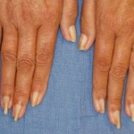Nuovo trattamento che utilizza l'acido tioglicolico per le unghie ad artiglio