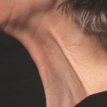 Efficacia e sicurezza dell'IncobotulinumtoxinA per il trattamento delle bande platismali nel collo invecchiato: uno studio pilota prospettico e in aperto