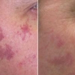 L'efficacia del trattamento con dye laser pulsato per le malattie infiammatorie della pelle: una revisione sistematica