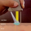 Laser alessandrite per il trattamento delle macchie vino-porto refrattarie al dye laser pulsato