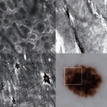 Caratteristiche della microscopia confocale a riflettanza in otto casi di eruzioni pustolose e, correlazioni istopatologiche