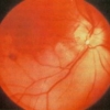 Occlusione iatrogena dell'arteria retinica causata da iniezioni di filler cosmetici facciali