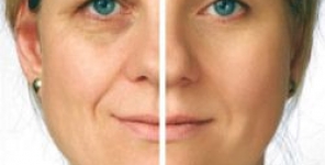 Efficacia della mesoterapia nel ringiovanimento facciale: una valutazione istologica ed immunoistochimica