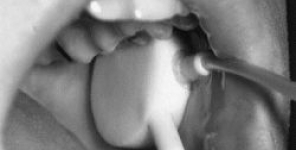 I livelli salivari di HNP 1-3 sono correlati con l'attività dell'ulcera orale nella malattia di Behçet