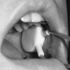I livelli salivari di HNP 1-3 sono correlati con l'attività dell'ulcera orale nella malattia di Behçet