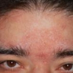 Reazioni cutanee simpatiche dello scalpo evocate attraverso la stimolazione elettrica, nella dermatite seborroica