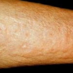 Enzimi della NADPH ossidasi nella fibrosi della pelle: bersagli molecolari e agenti terapeutici