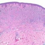 Strutture a rosetta nello spettro dei tumori spitzoidi