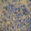 Sifilide del mondo dei funghi: Nuove manifestazioni cutanee di istoplasmosi in un ospite immunocompetente