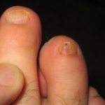 Efinaconazolo al 10% per il trattamento dell'onicomicosi alle unghie dei piedi: due studi multicentrici di fase III, randomizzati e in doppio cieco