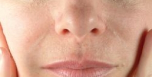 Lesioni orali associate con filler cosmetico iniettato di idrossiapatite