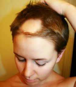 Alopecia-areata