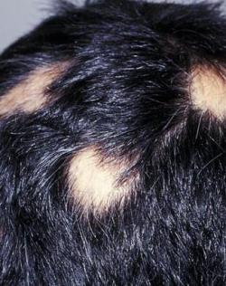 Alopecia-Areata11