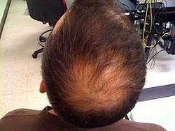 Androgenetic-Alopecia