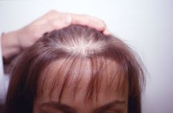 androgenic-alopecia