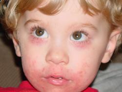 Childhood-Granulomatous-Periorificial-Dermatitis