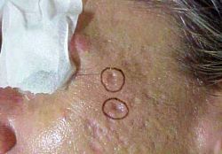 cicatrici atrofiche da acne
