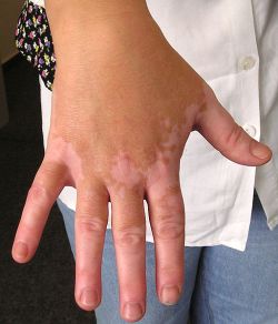 Clinical-patterns-of-vitiligo