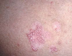 epidermolysis-bullosa-acquisita