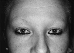 Eyebrow-Hypotrichosis